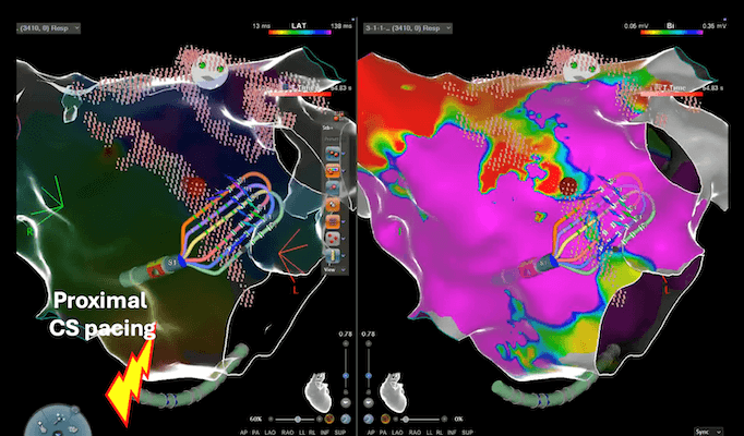 Johnson Johnson MedTech Receives CE Mark For OPTRELL Mapping Johnson Johnson MedTech Receives CE Mark For OPTRELL Mapping